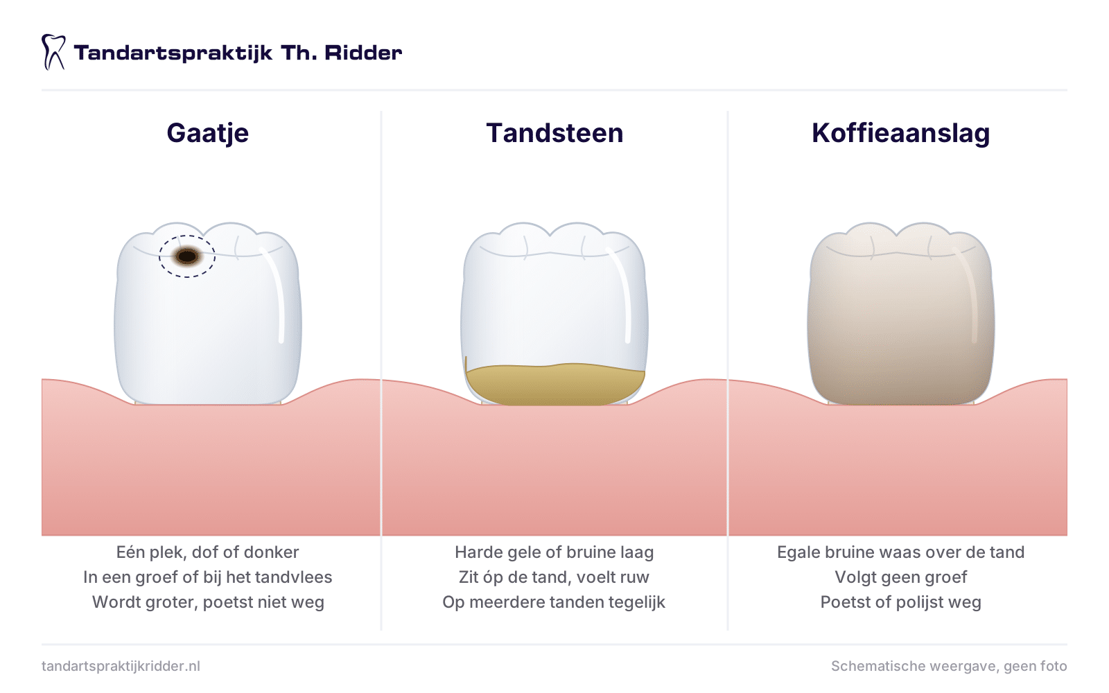 verschil gaatje en aanslag